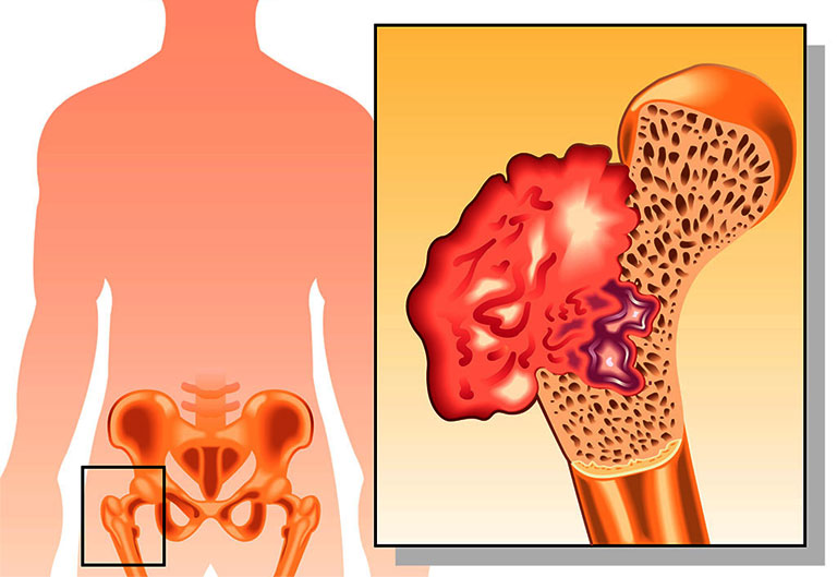 U xương sụn có tên y khoa là osteochondroma khá phổ biến